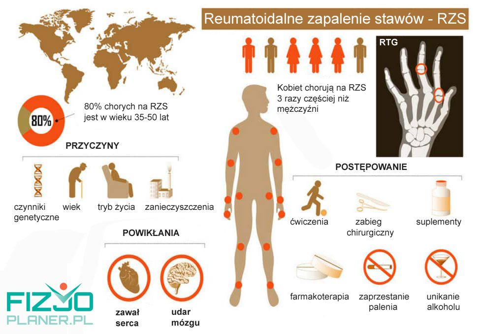 Reumatoidalne zapalenie stawow RZS - infografika