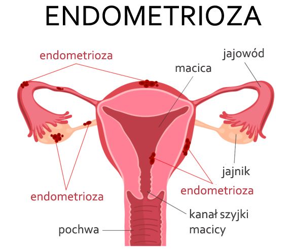 endometrioza ilustracja