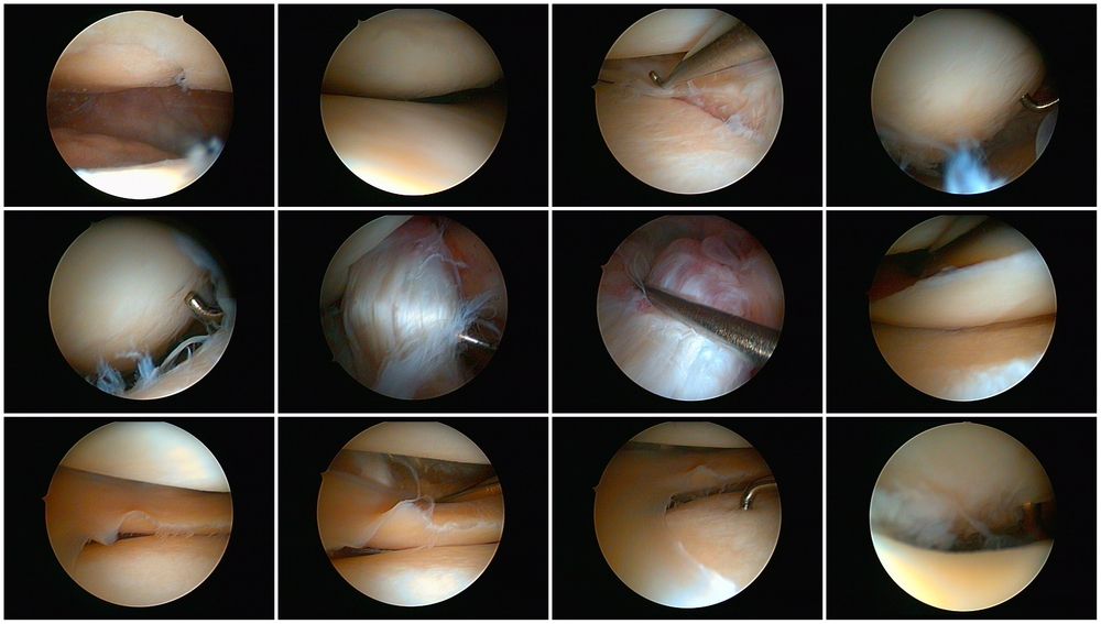 zdjęcia z artroskopii kolana