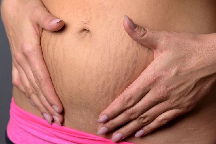 rozstępy na brzuchu po ciąży
