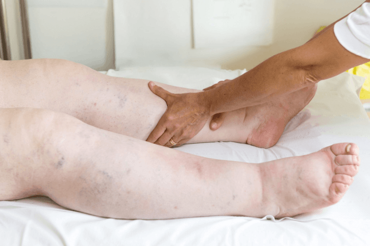 Drenaż (masaż) limfatyczny - terapia przeciwobrzękowa
