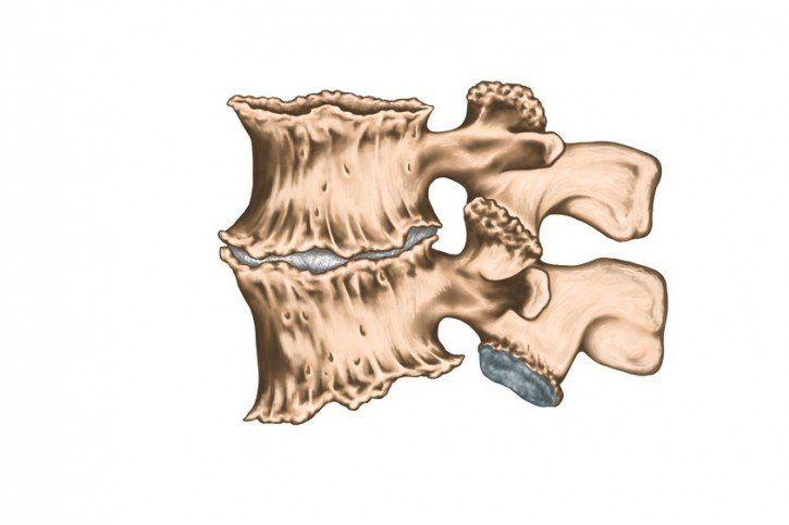 Osteofity - przyczyny, objawy, leczenie 