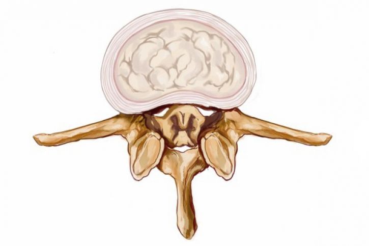 Stenoza kanału kręgowego