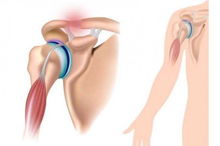 zwyrodnienie stawu barkowego ćwiczenia este posibilă vindecarea artrozei articulației șoldului